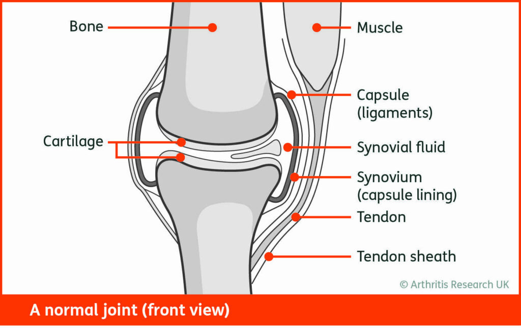 The Stages of Rheumatoid Arthritis – Established Disease - Rheumatology ...